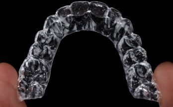 Why Permanent Dental Retainers Still Require Professional Monitoring